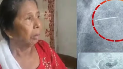 കുത്തിവെപ്പെടുത്തപ്പോള്‍ സൂചി ഒടിഞ്ഞു, ദുരിതവുമായി വത്സല കഴിഞ്ഞത് ഒരു വര്‍ഷം