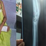 ക്ലാസിൽ ശ്രദ്ധിച്ചില്ല; അഞ്ചാം ക്ലാസുകാരിയെ ചൂരൽ കൊണ്ട് അടിച്ച് അധ്യാപകൻ, കൈ എല്ല് പൊട്ടി